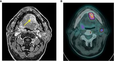 High-grade transformation of a polymorphous adenocarcinoma of the salivary gland: a case report and review of the literature